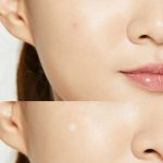 ⁦كوسركس لصقات علاج حب الشباب والبثور - 24 قطعة⁩ - الصورة ⁦3⁩