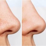 ⁦انوا غسول زيتي هارتليف للتحكم في المسام - 200 مل⁩ - الصورة ⁦5⁩